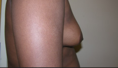 Gynecomastia Before and After Pictures Atlanta, GA