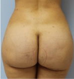 Brazilian Butt Lift Before and After Pictures Atlanta, GA