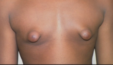 Gynecomastia Before and After Pictures Atlanta, GA