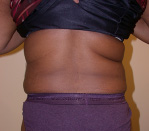 Liposuction Before and After Pictures Atlanta, GA