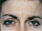Brow Lift Before and After Pictures Atlanta, GA