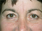 Brow Lift Before and After Pictures Atlanta, GA