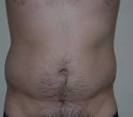 Liposuction Before and After Pictures Atlanta, GA