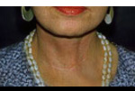 Facelift Before and After Pictures Atlanta, GA