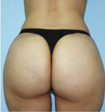 Brazilian Butt Lift Before and After Pictures Atlanta, GA