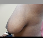 Breast Reduction Before and After Pictures Atlanta, GA