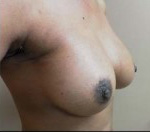 Breast Augmentation in Atlanta, GA