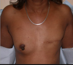 Breast Reconstruction in Atlanta, GA