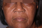 Facelift Before and After Pictures Atlanta, GA