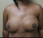 Breast Reconstruction in Atlanta, GA