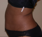 Tummy Tuck Before and After Pictures Atlanta, GA
