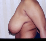 Breast Reduction Before and After Pictures Atlanta, GA