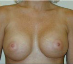 Breast Augmentation in Atlanta, GA