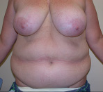 Tummy Tuck Before and After Pictures Atlanta, GA
