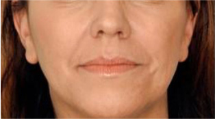 Soft Tissue Fillers Before and After Pictures Atlanta, GA