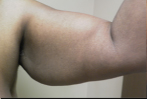 Arm Lift Before and After Pictures Atlanta, GA