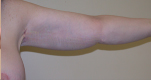 Arm Lift Before and After Pictures Atlanta, GA