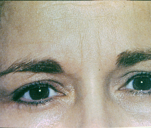 Botox Before and After Pictures Atlanta, GA
