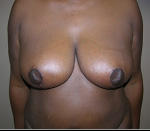 Breast Lift in Atlanta, GA