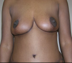 Breast Lift in Atlanta, GA