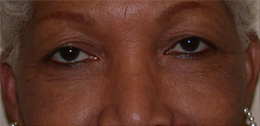 Blepharoplasty Before and After Pictures Atlanta, GA