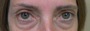 Blepharoplasty Before and After Pictures Atlanta, GA