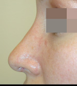 Rhinoplasty Before and After Pictures Atlanta, GA