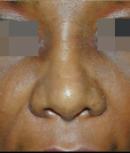 Rhinoplasty Before and After Pictures Atlanta, GA