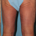 Thigh Lift Before and After Pictures Atlanta, GA