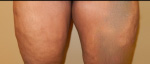 Thigh Lift Before and After Pictures Atlanta, GA