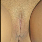 Labiaplasty Before and After Pictures Atlanta, GA