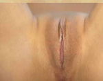 Labiaplasty Before and After Pictures Atlanta, GA