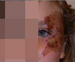Wound Care Before and After Pictures Atlanta, GA