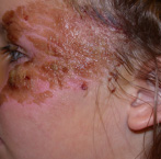 Wound Care Before and After Pictures Atlanta, GA