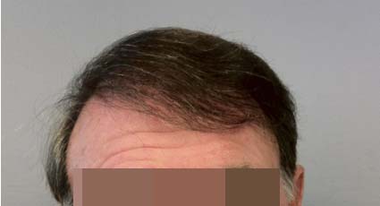 Hair Restoration for Men Before and After Pictures Atlanta, GA