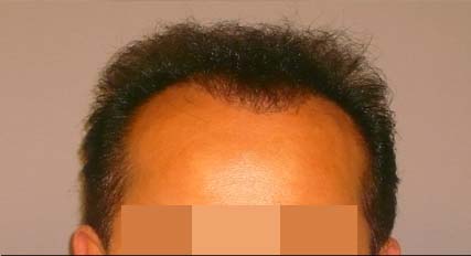Hair Restoration for Men Before and After Pictures Atlanta, GA