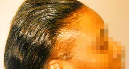 Hair Restoration for Women Before and After Pictures Atlanta, GA