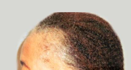 Hair Restoration for Women Before and After Pictures Atlanta, GA